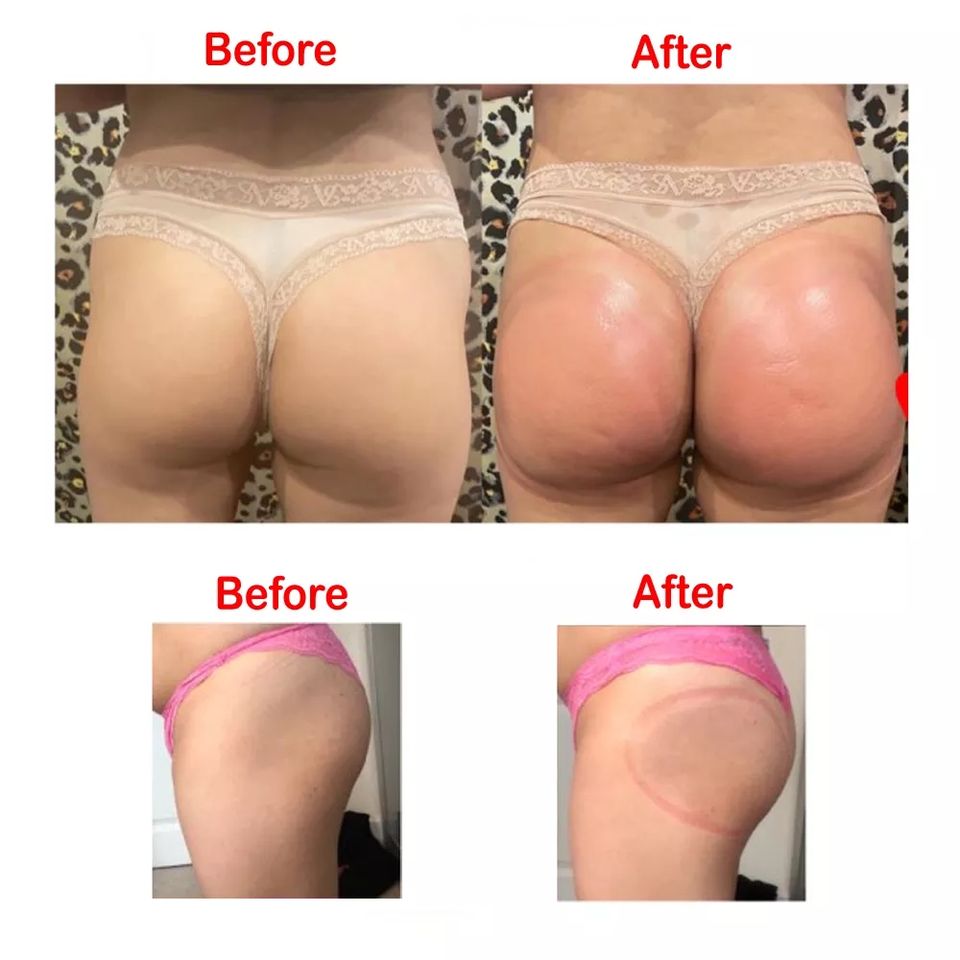Butt Lifting Vacuum Therapy Xxxl Cups/Vacuum Suction Cup Therapy/Breast Enhancement Buttocks Enlargement Machine image 5
