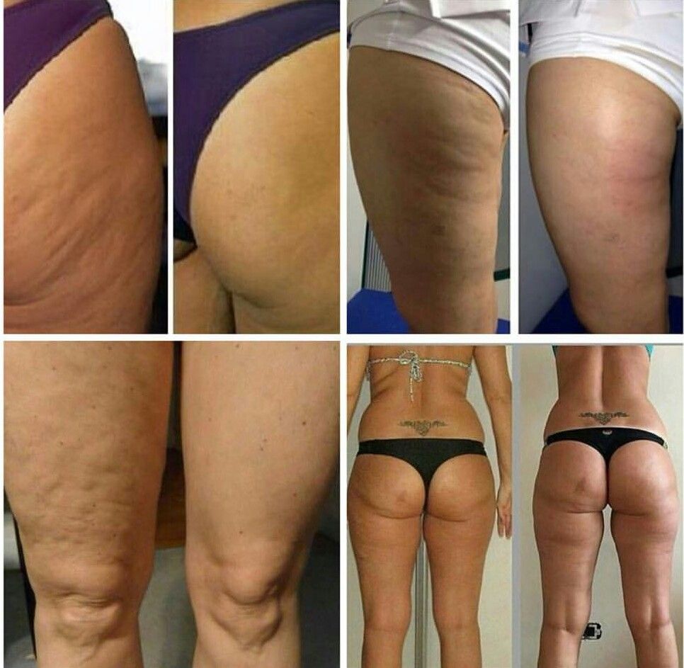 Body Slimming Contouring Cellulite Removal Machine Kuma Shape Pro